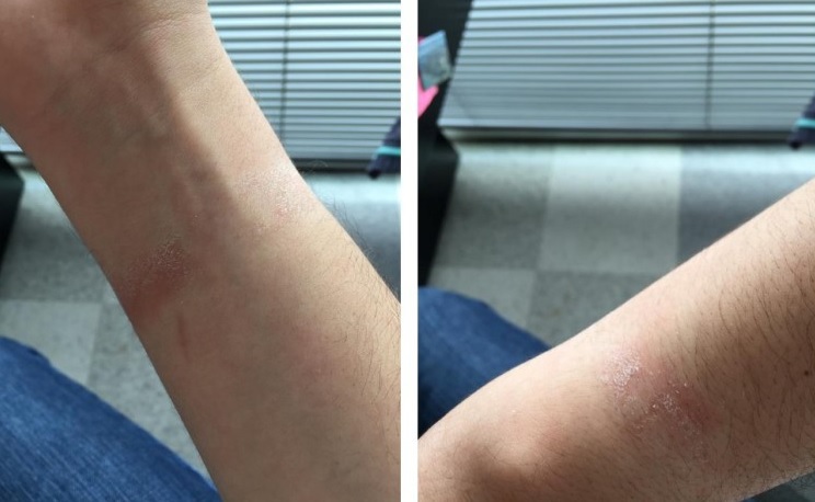 Apple Watch Allergo