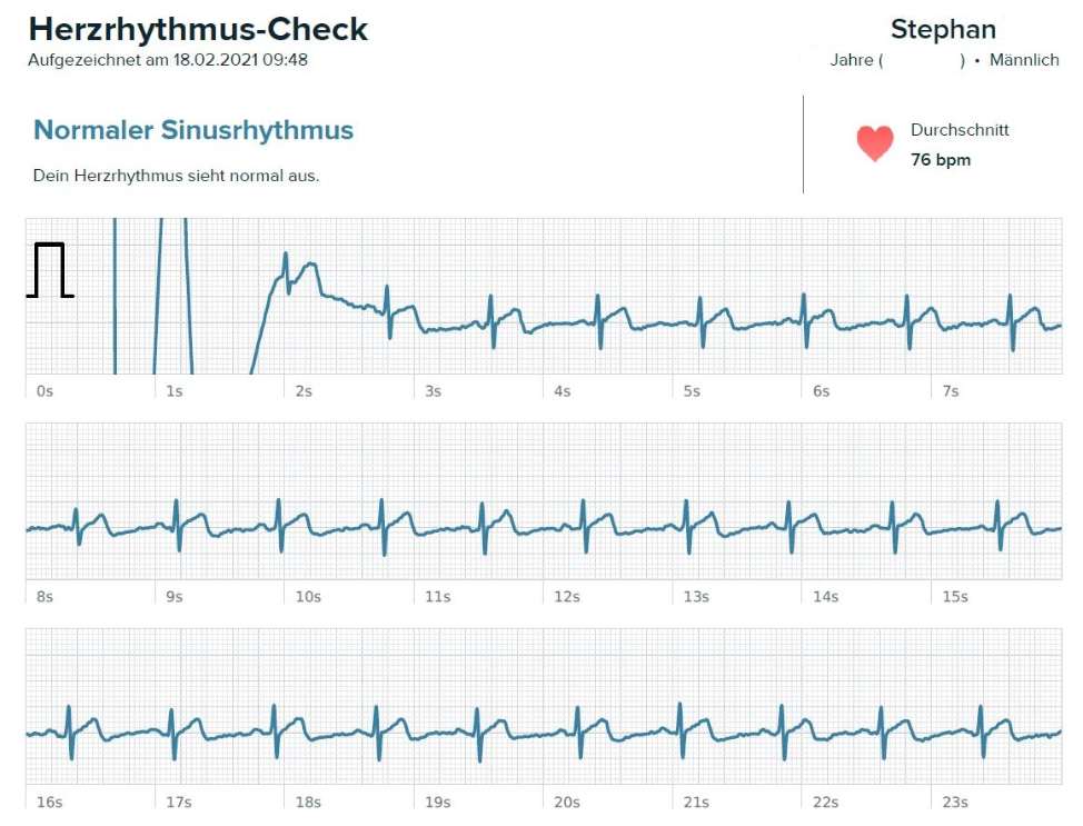 fitbit sense smartwatch test ekg auswertung
