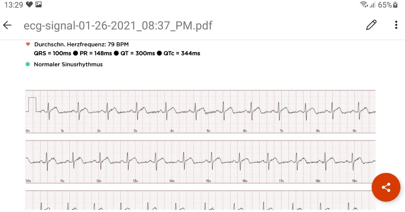withings scanwatch smartwatch test ekg